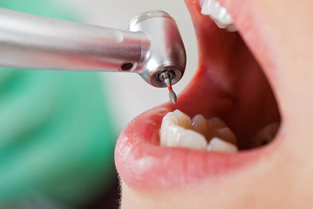 Best Emergency Root Canal Therapy in St Peter, WI